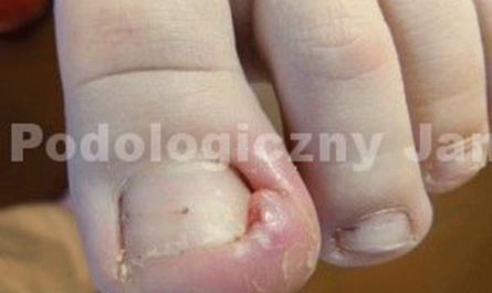 ingrowing-toenail-GP-JC-300x240
