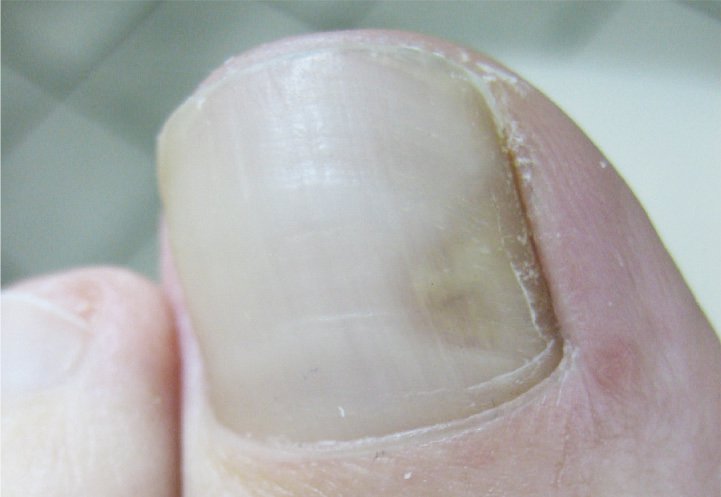 Łuszczyca paznokci – fragment książki „Wielka księga chorób paznokci”