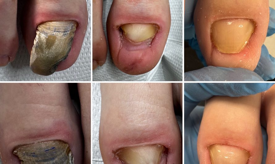 Kiedy góry zostawiają ślad – przypadek pourazowej deformacji paznokci po wyprawie górskiej